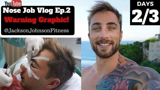 'Nose Job Vlog Ep.2 | Warning Graphic & Emotional Day 2/3 | Jackson Johnson Fitness'