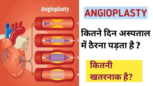 'एनजीओप्लास्टि क्या है । Angioplasty procedure in hindi । Guru mann fitness'