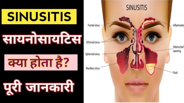 'साइनोसाइटिस क्या है। sinusitis symptoms and treatment in hindi । Guru mann fitness'