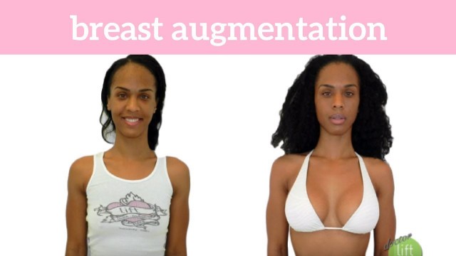 'Yasmine: A Fitness Model\'s Story on Her Own Breast Augmentation'